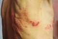 Shingles is a viral infection that causes a painful rash Royalty Free Stock Photo