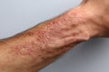 Shingles virus causing blisters and rash on skin, causing pain and itching Royalty Free Stock Photo