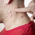 Shingles virus Royalty Free Stock Photo