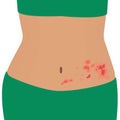 Shingles on a woman body varicella zoster vector illustration