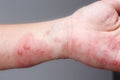 Shingles, Zoster or Herpes Zoster symptoms on arm Royalty Free Stock Photo