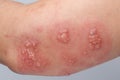 Shingles, Zoster or Herpes Zoster symptoms on arm Royalty Free Stock Photo