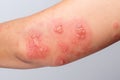 Shingles, Zoster or Herpes Zoster symptoms on arm