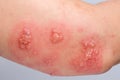 Shingles, Zoster or Herpes Zoster symptoms on arm Royalty Free Stock Photo