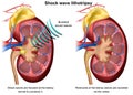 Shock wave lithotripsy 3d medical illustration on white background