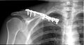 Sholder fraction Clavicle xray