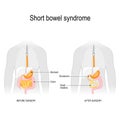 Short gut. Before surgery and after surgery.