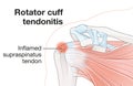 Shoulder anatomy. Rotator cuff tendonitis Royalty Free Stock Photo