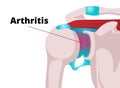 Shoulder arthritis vector illustration