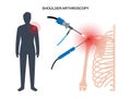 Shoulder arthroscopy poster Royalty Free Stock Photo