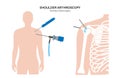 Shoulder arthroscopy poster Royalty Free Stock Photo