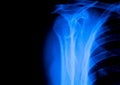 Shoulder back ribs Xray scan Royalty Free Stock Photo