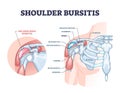 Shoulder bursitis as medical painful bursa inflammation outline diagram Royalty Free Stock Photo