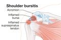 Shoulder bursitis. Inflamed bursa and supraspinatus tendon Royalty Free Stock Photo