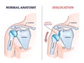 Shoulder dislocation and humerus bone trauma explanation outline diagram