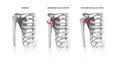 Shoulder dislocation options Royalty Free Stock Photo