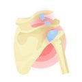 Shoulder dislocation, rupture of tendon, ligament, joints. Musculoskeletal trauma, injury. Royalty Free Stock Photo
