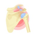 Shoulder dislocation, rupture of tendon, ligament, joints. Musculoskeletal trauma, injury.