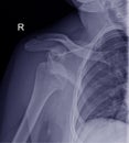 Shoulder fracture digital radiograph