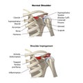 Shoulder impingement, , medical posters with symbols, vector illustration Royalty Free Stock Photo