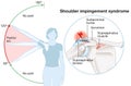 Shoulder impingement. Painful arc. Labeled illustration