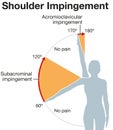 Shoulder impingement. Painful arc. Labeled Illustration