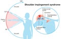 Shoulder impingement sydrome. Painful arc. Labeled Illustration