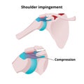 Shoulder impingement vector illustration. Illustration of the muscle tendon and bursa compression Royalty Free Stock Photo