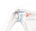 Shoulder joint. Calcific tendinitis and bursitis Royalty Free Stock Photo