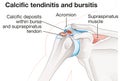 Shoulder joint. Calcific tendinitis and bursitis Royalty Free Stock Photo