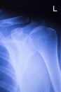 Shoulder joint orthopedic xray scan