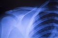 Shoulder joint orthopedic xray scan