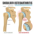 Shoulder osteoarthritis infographic