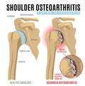 Shoulder osteoarthritis infographic