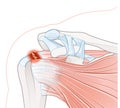 Shoulder pain. Rotator cuff tear