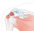 Shoulder pain. Shoulder bursitis Royalty Free Stock Photo