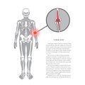 Shoulder prosthesis, vector banner with place for text. Medical illustration