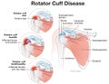 Shoulder Rotator Cuff Disease Illustration. Labeled Royalty Free Stock Photo