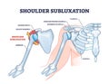 Shoulder subluxation as partial dislocated arm joint problem outline diagram