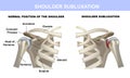 Shoulder subluxation, healthy shoulder joint and shoulder joint with subluxation, medical material with symbols
