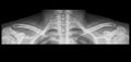 Shoulder X-ray