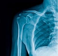 Shoulder x-ray banner, shoulder x-ray on black background Royalty Free Stock Photo