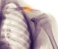 Shoulder x-ray, clavicle (collarbone) fracture Royalty Free Stock Photo