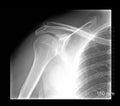 Shoulder xray Royalty Free Stock Photo