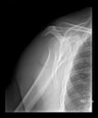 Shoulder xray