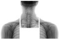 Shoulders and neck x ray images Royalty Free Stock Photo