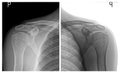 Shoulders x ray images Royalty Free Stock Photo