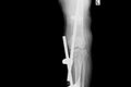 X-ray image of fracture leg with implant external fixation.