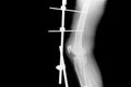 X-ray image of fracture leg with implant external fixation.