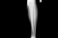 Show image of tibia and fibula left lateral